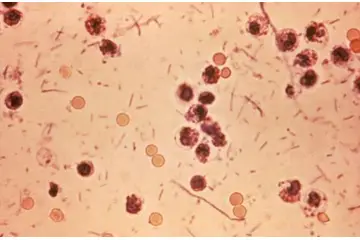 Basilli Dizanteri Belirtileri ve Tedavisi